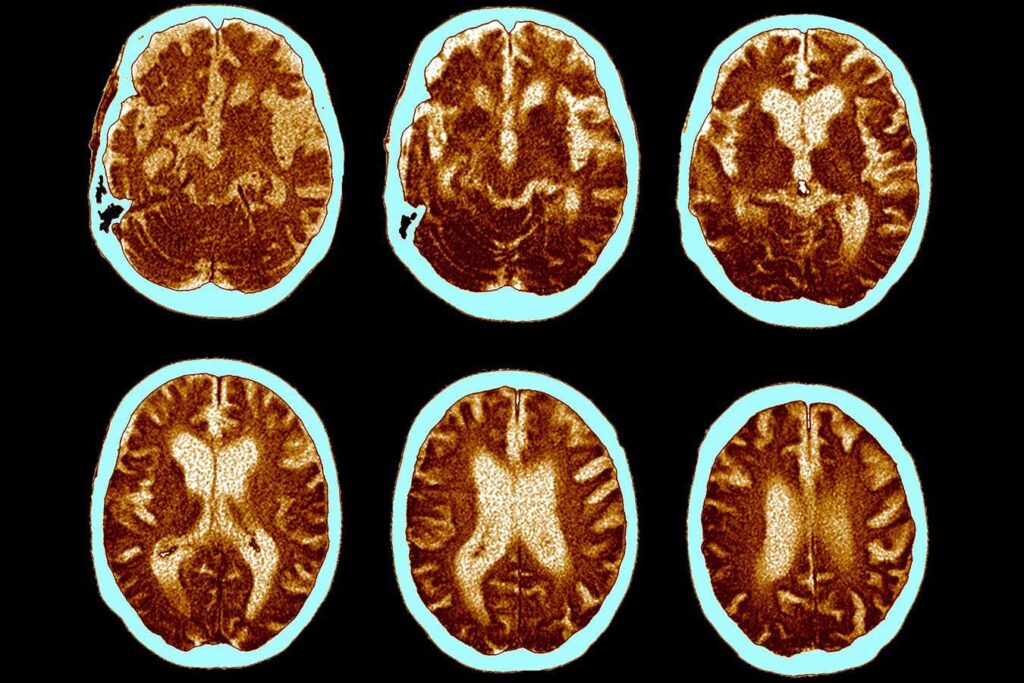 We’ll learn about Ozempic’s potential for Alzheimer’s disease in 2025